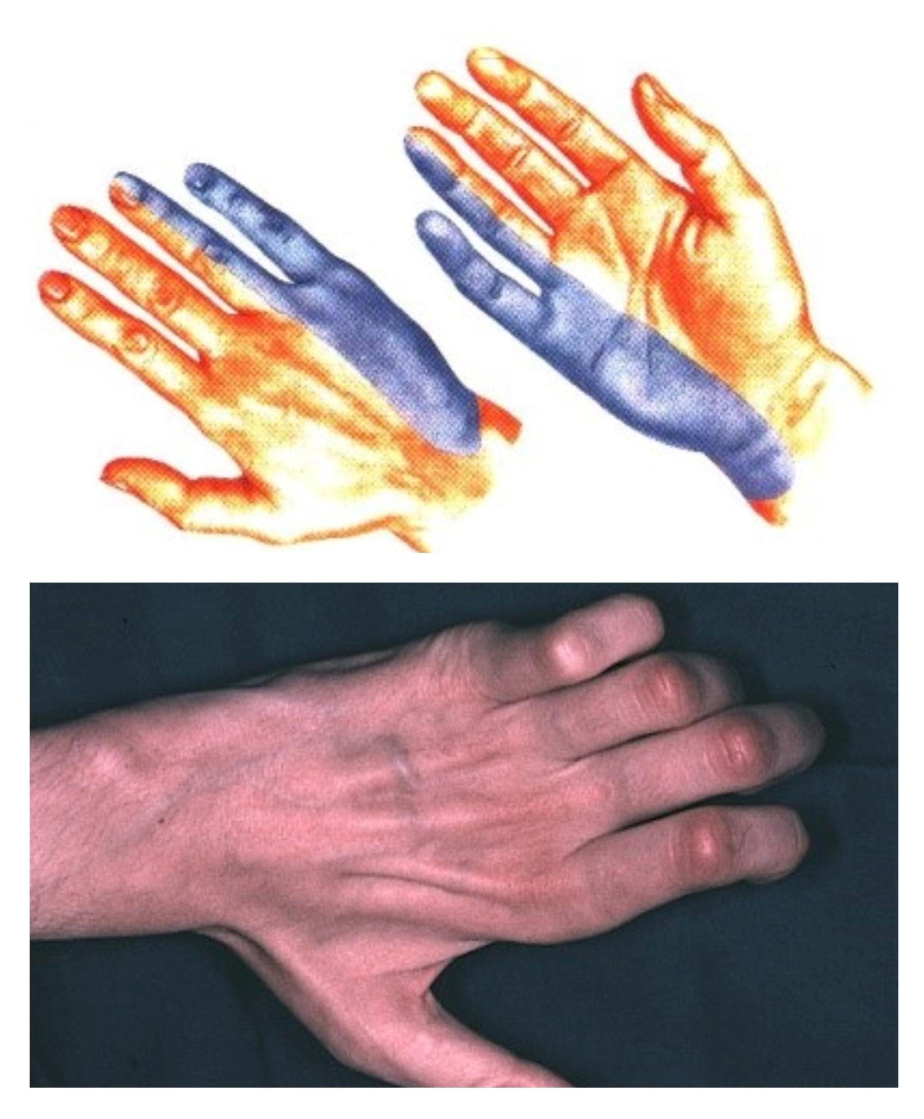 Kubitālā kanāla sindroma ādas inervācijas zona